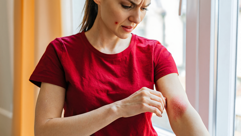 Woman on the Louisiana Northshore checking a poison ivy rash on her forearm at home